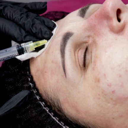 Acne-Scar-Treatment-with-PRP-2