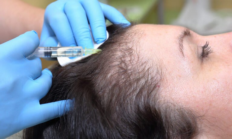 PRP for Hair Restoration