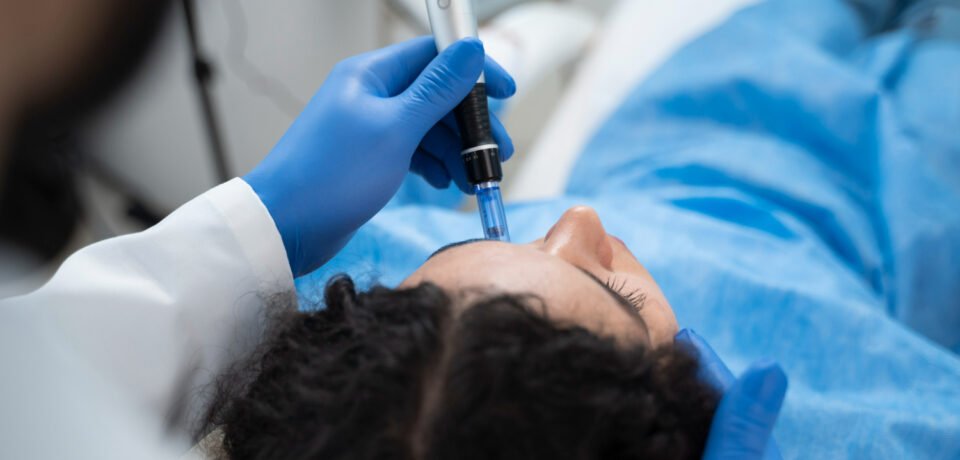 microneedling_results Microneedling Results